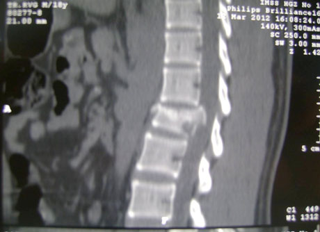 Imagen de un fractura vertebral.