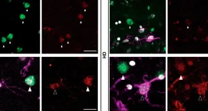 Identifican una proteína clave para la supervivencia de las neuronas en la enfermedad de Huntington
