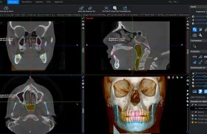 ¿Puede la inteligencia artificial ver lo que el ojo humano no ve? Inteligencia artificial y tomografía de haz cónico en odontología
