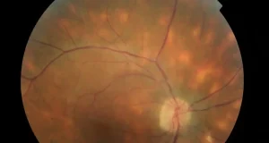 Todo sobre la uveítis: información clave para cuidar tu salud ocular