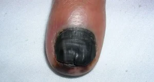Nace un tratamiento que permite conservar los dedos ante uno de los cánceres de piel más agresivos: el melanoma en la uña