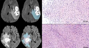 Una herramienta basada en inteligencia artificial ayuda a identificar zonas tumorales ocultas del glioblastoma para orientar la planificación quirúrgica