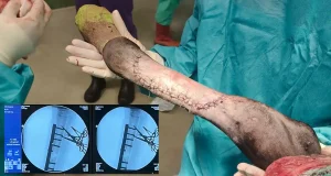 El Hospital Veterinario de la ULE salva la vida a un burro de ocho meses mediante una operación quirúrgica inédita