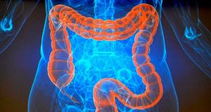 Si tienes uno de estos hábitos alimenticios, o has sufrido alguna de estas patologías, tienes más posibilidades de sufrir cáncer de colon