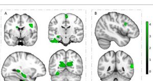 Regiones cerebrales que muestran asociaciones independientes positivas de velocidad cardiorrespiratoria y agilidad de velocidad con volumen de materia gris en niños con sobrepeso u obesidad.