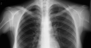 La UMH dirige el proyecto para detectar la Covid-19 mediante radiografías e inteligencia artificial
