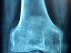 Una aplicación española es capaz de registrar de forma objetiva la carga osteogénica que recibe el hueso durante la actividad física
