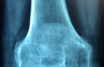 Una aplicación española es capaz de registrar de forma objetiva la carga osteogénica que recibe el hueso durante la actividad física