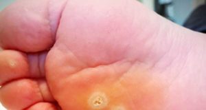 Mejoran el diagnóstico de verrugas del pie con PCR similares a las utilizadas con el covid
