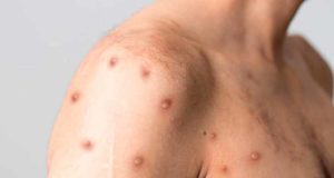 Viruela del mono: nuevo estudio para comprobar la efectividad de las vacunas ante las nuevas cepas del virus