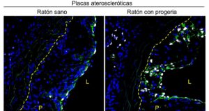 Identifican un nuevo mecanismo por el que se desarrolloa la arterosclerosis precoz