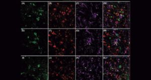 Identifican tres proteínas asociadas al alzhéimer que ayudarían mejorar su diagnóstico y tratamiento