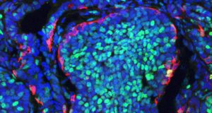 Descubren un doble papel de las células cancerosas: compiten a favor y en contra del tumor