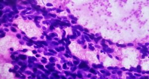 Quimioterapia oral: un nuevo proyecto para estudiar porqué algunos pacientes rechazan los genéricos