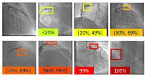 Un nuevo sistema identifica enfermedades cardiovasculares solo con una imagen