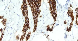 La firma genética para identificar el cáncer de mama y predecir su pronósitico