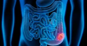 Nuevas estrategias para combatir la diverculitis: esta enfermedad está asociada a los hábitos de vida