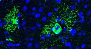 Una posible diana terapéutica contra el Alzhéimer: la proteína que origina cambios en el cerebro