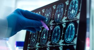 La escala de riesgo genético de alzhéimer más completa obtenida hasta ahora