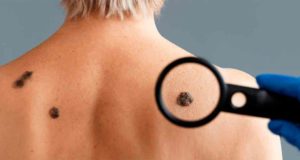 Cómo tratar las verrugas para eliminarlas y evitar que se extiendan por el cuerpo