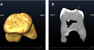 El curioso origen de la caries de un neandertal que vivió en Asturias hace 49.000 años