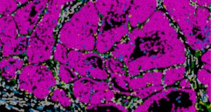 La metástasis no es fruto del azar: viene escrita en unas células determinadas del tumor