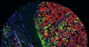 Descubren una nueva estrategia para frenar la metástasis del melanoma y mejorar la inmunoterapia