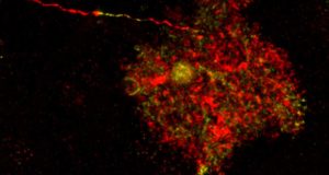 Descubren que unos astrocitos considerados hasta ahora inocuos causan enfermedades cerebrales