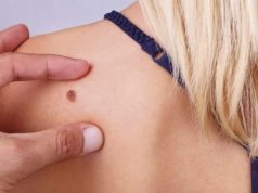 Una inteligencia artificial de la UA ayuda a detectar cáncer de piel con una foto