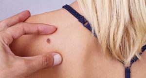 Moléculas derivadas del té verde mejoran la inmunoterapia frente al melanoma metastásico