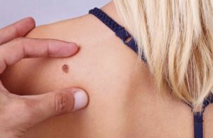 Una inteligencia artificial de la UA ayuda a detectar cáncer de piel con una foto