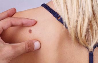 Una inteligencia artificial de la UA ayuda a detectar cáncer de piel con una foto