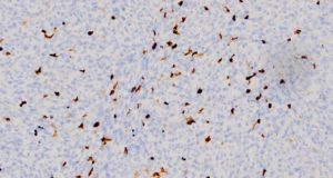 Frenan el crecimiento del cáncer con pulsos electromagnéticos