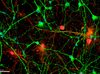 Una proteína aumenta en el cerebro y el líquido cefalorraquídeo de pacientes con alzhéimer