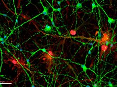 Una proteína aumenta en el cerebro y el líquido cefalorraquídeo de pacientes con alzhéimer