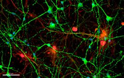 Una proteína aumenta en el cerebro y el líquido cefalorraquídeo de pacientes con alzhéimer