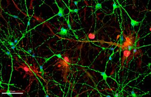 Una proteína aumenta en el cerebro y el líquido cefalorraquídeo de pacientes con alzhéimer