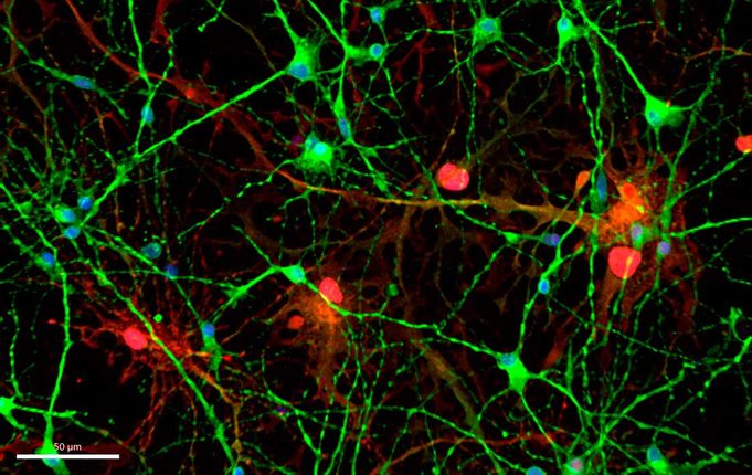 Una proteína aumenta en el cerebro y el líquido cefalorraquídeo de pacientes con alzhéimer