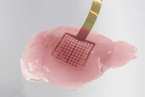 Una nueva tecnología de grafeno monitoriza el cerebro tras un ictus y detecta tejido en riesgo